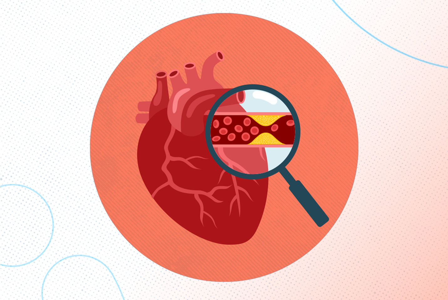 Atherosclerosis vs arteriosclerosis